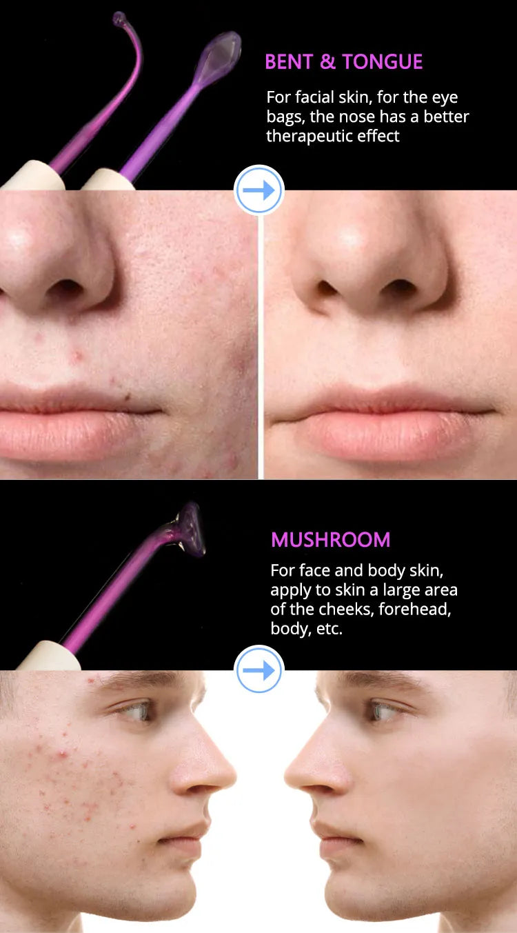 High Frequency Facial Machine with Argon Treatment - Electrotherapy Wand for Acne and Hair Care